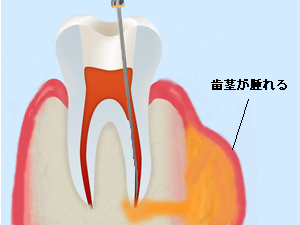 の 治療 後 痛い 歯 いつまで続くこの痛み！歯の治療中、治療後の歯痛の原因と対処法